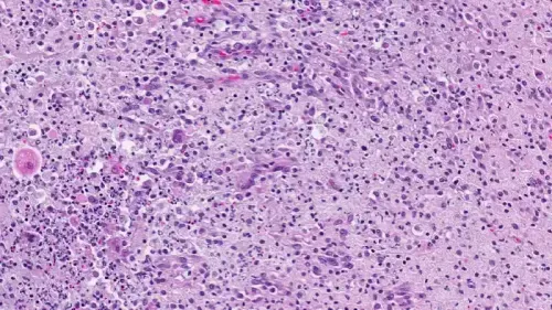 What Are the 4 Granulomatous Diseases?